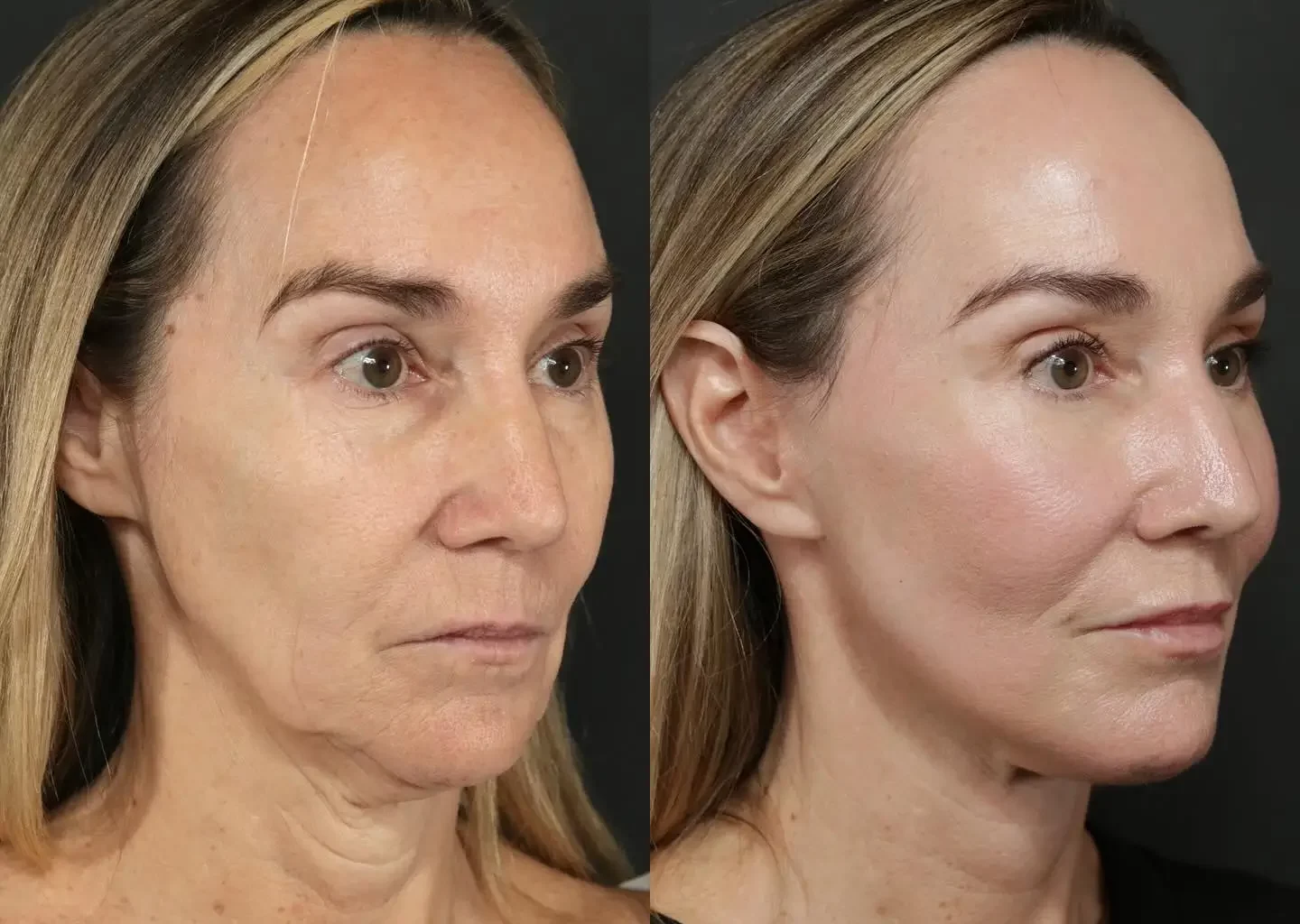 Face Lift Before and After: What Results Actually Look Like